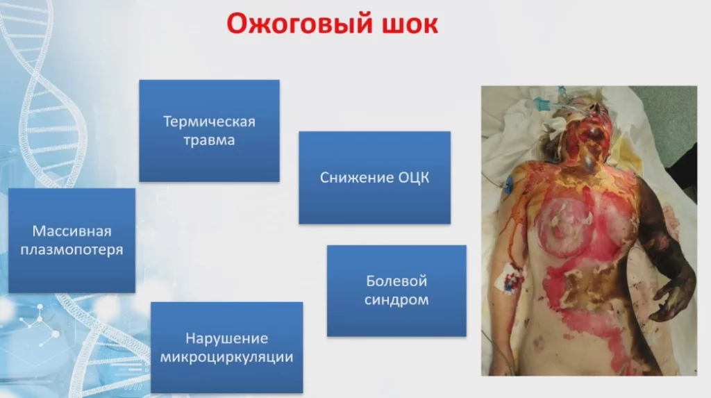 Ожоговый шок.jpg Ожоговый шок.jpg